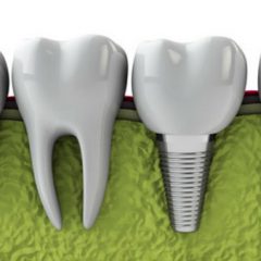 All You Need to Know About Dental Implants
